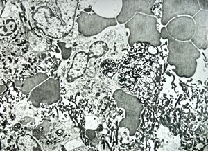 F,68y. | spleen - myelinoid inclusions - clin. susp. leukemia F,68y. | spleen - myelinoid inclusions - clin. susp. leukemia